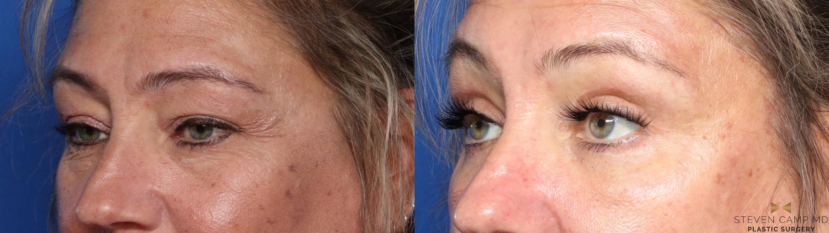 Before & After Blepharoplasty Case 565 Right Oblique View in Fort Worth & Arlington, Texas