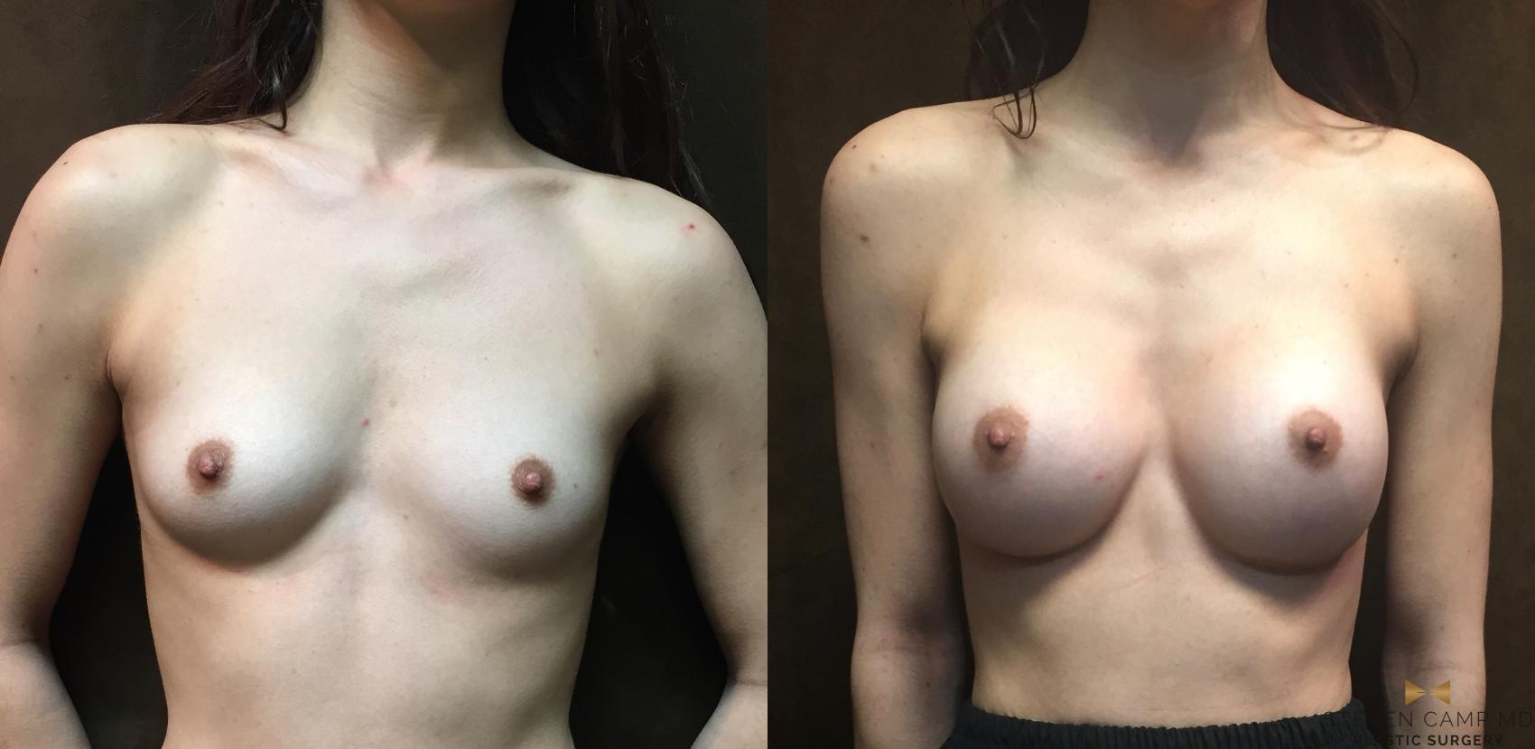 Before & After Breast Augmentation Case 57 View #1 View in Fort Worth & Arlington, Texas