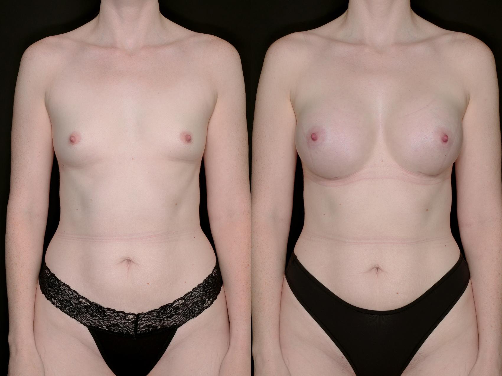 Before & After Breast Augmentation Case 735 Front View in Fort Worth & Arlington, Texas
