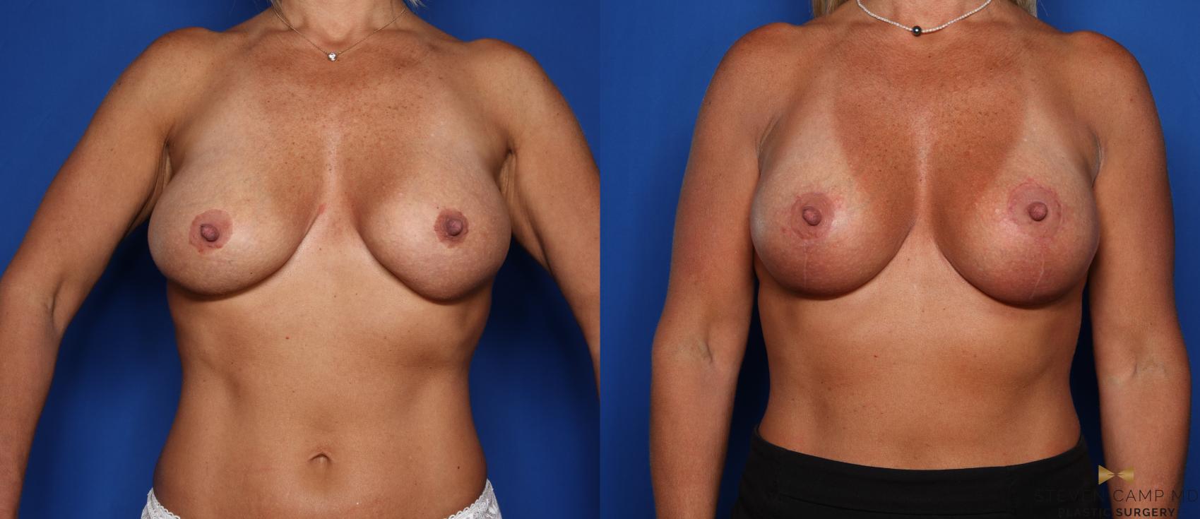 Before & After Breast Implant Exchange (Breast Revision) Case 345 Front View in Fort Worth & Arlington, Texas