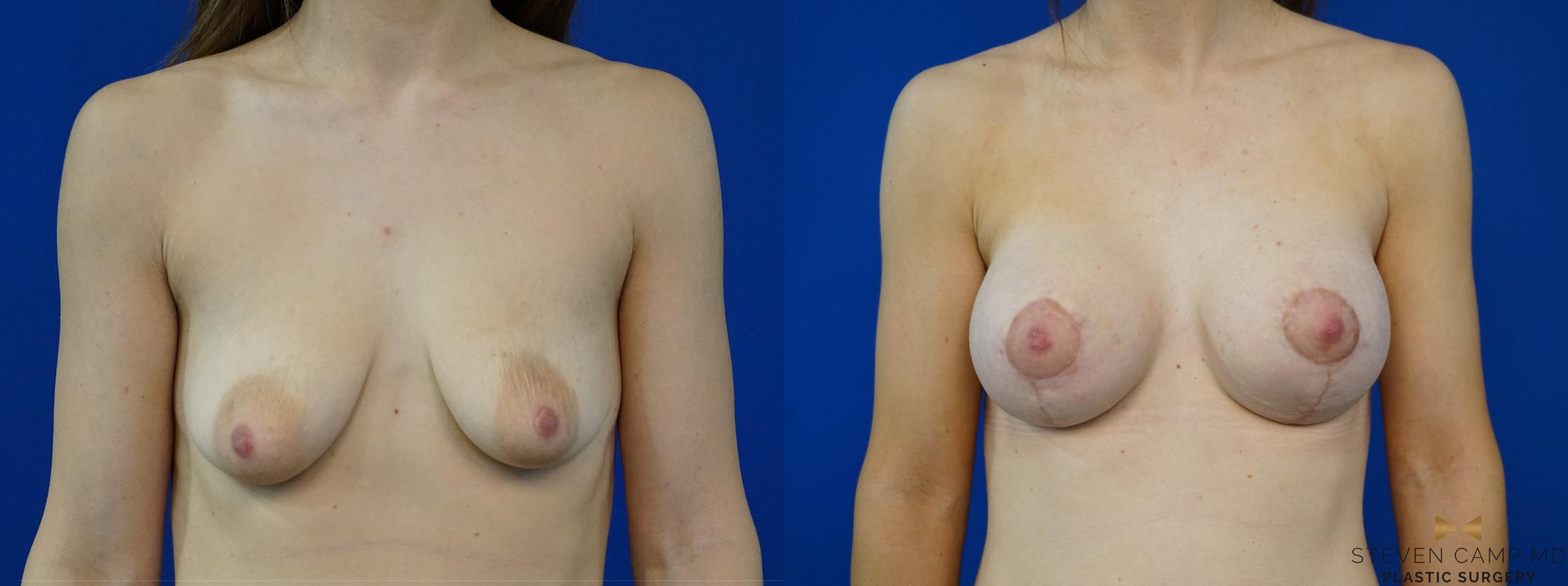 Breast Lift with or without Implants Before & After Photo | Fort Worth, Texas | Steven Camp MD Plastic Surgery