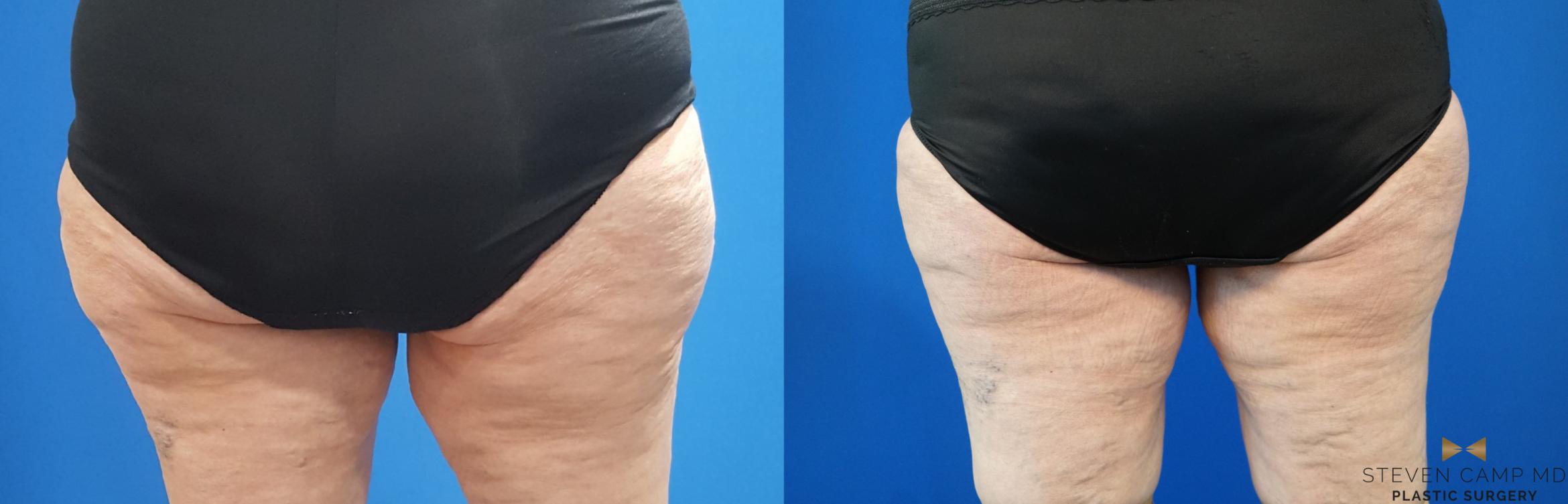 CoolSculpting Before & After Photo | Fort Worth, Texas | Steven Camp MD Plastic Surgery