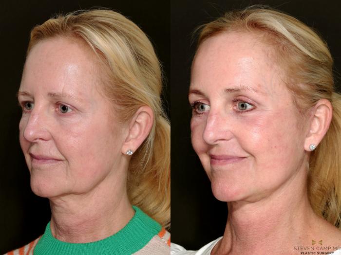 Before & After Necklift Case 715 Left Oblique View in Fort Worth & Arlington, Texas