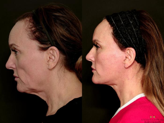 Before & After Sciton Laser Case 716 Left Side View in Fort Worth & Arlington, Texas