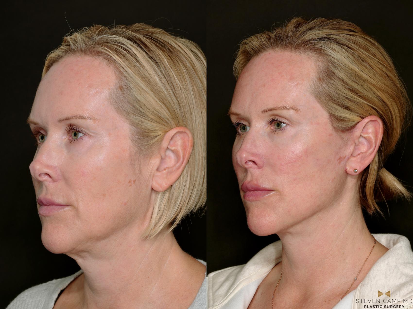 Before & After Deep Plane Facelift Case 722 Left Oblique View in Fort Worth & Arlington, Texas