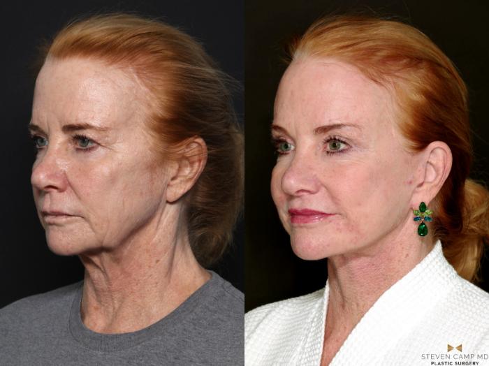 Before & After Brow Lift Case 723 Left Oblique View in Fort Worth & Arlington, Texas