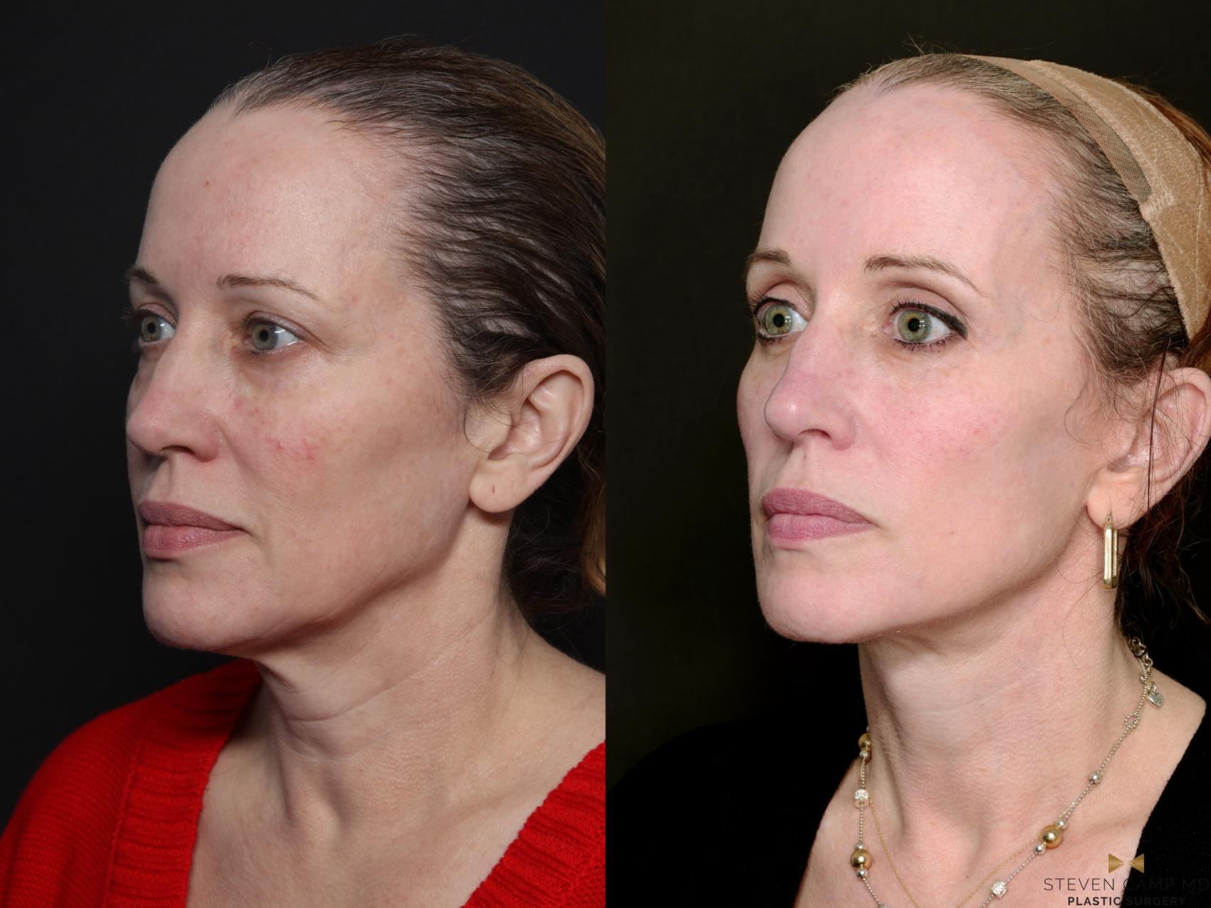 Before & After Deep Plane Facelift Case 727 Left Oblique View in Fort Worth & Arlington, Texas