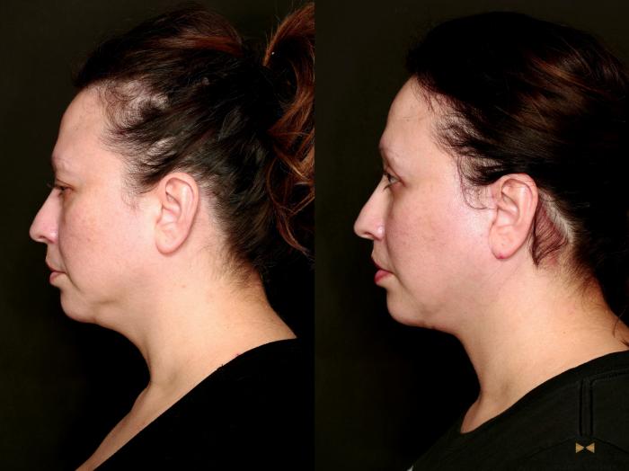 Before & After Facial Fat Grafting Case 743 Left Side View in Fort Worth & Arlington, Texas