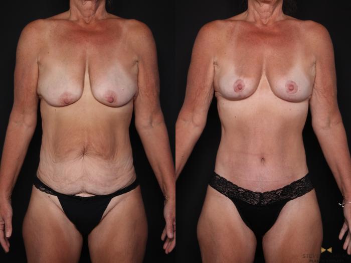 Before & After Breast Lift (Breast Mastopexy - No Implants) Case 725 Front View in Fort Worth & Arlington, Texas