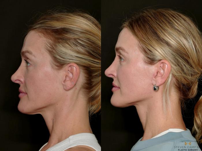 Before & After Necklift Case 717 Left Side View in Fort Worth & Arlington, Texas