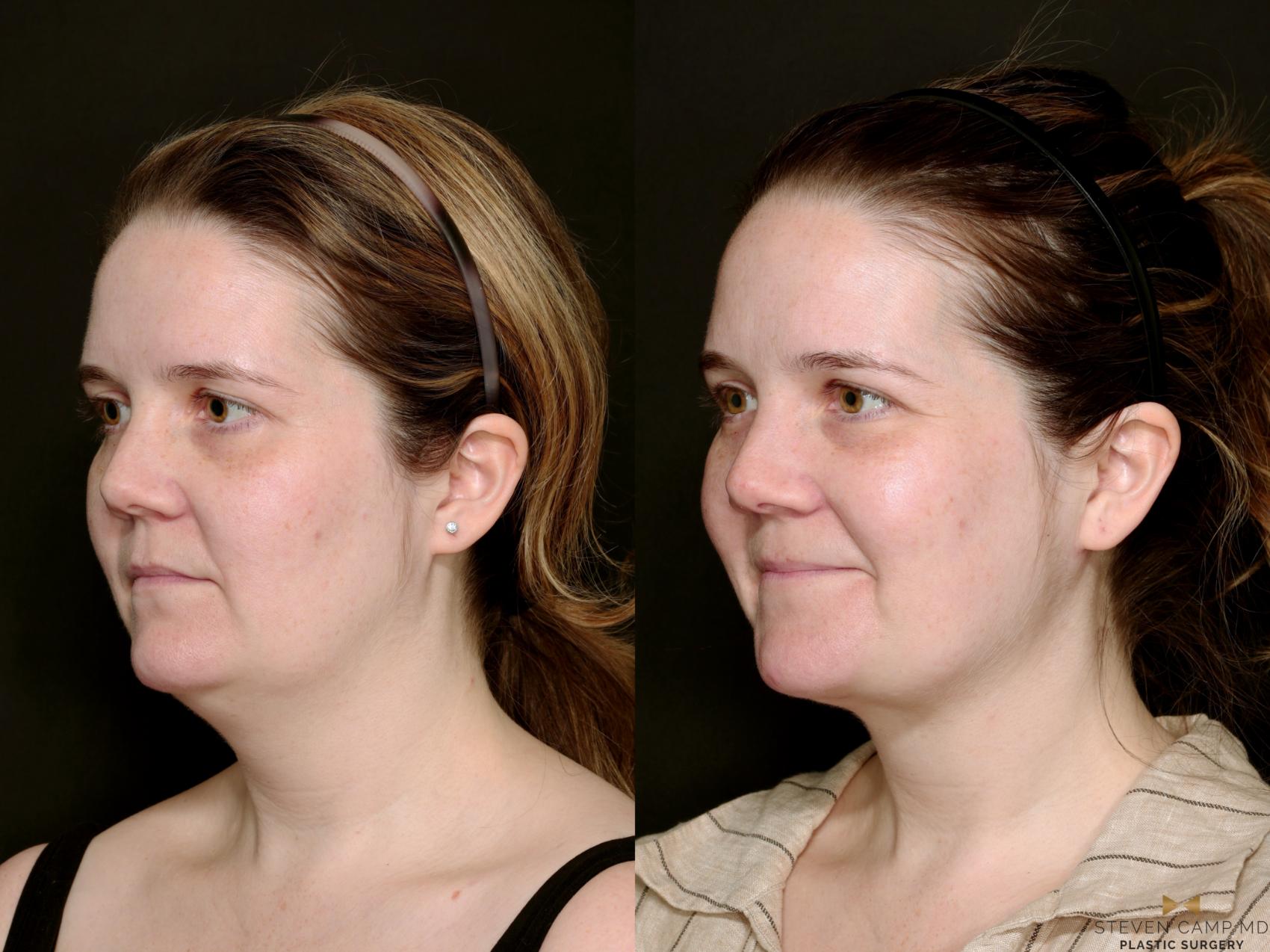 Before & After Necklift Case 719 Left Oblique View in Fort Worth & Arlington, Texas