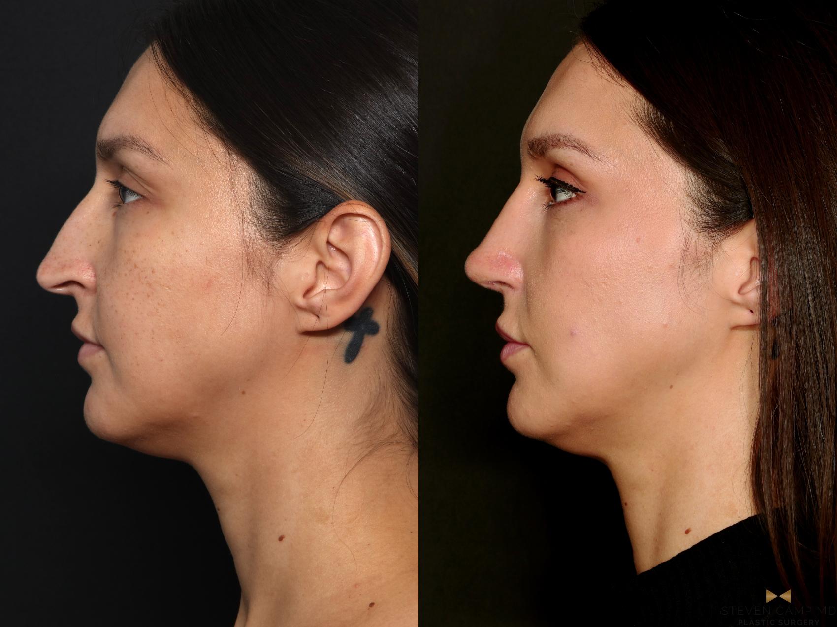 Before & After Rhinoplasty Case 724 Left Side View in Fort Worth & Arlington, Texas