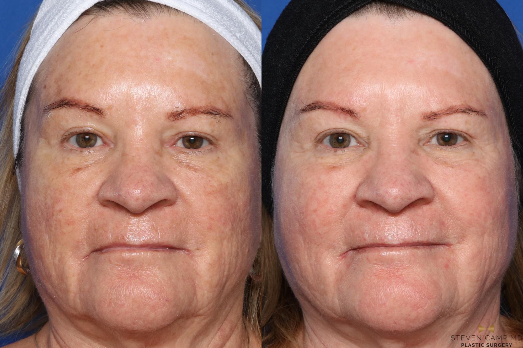 Sciton Laser Before & After Photo | Fort Worth, Texas | Steven Camp MD Plastic Surgery