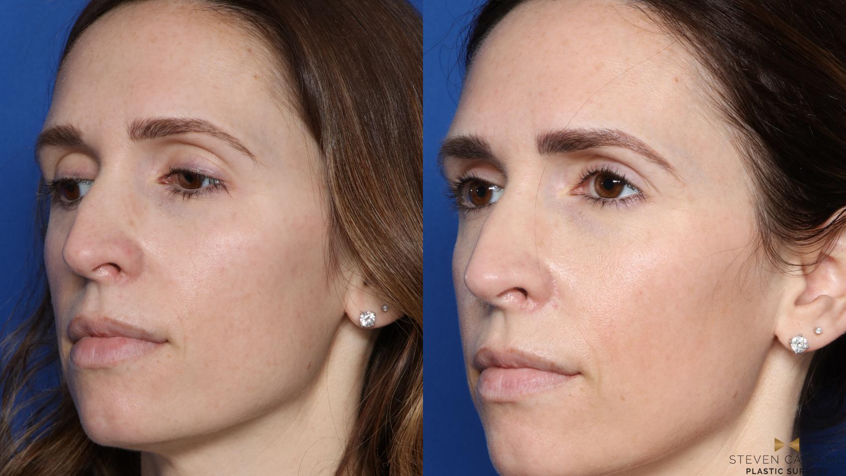 Before & After Sciton Laser Case 448 Left Oblique View in Fort Worth & Arlington, Texas