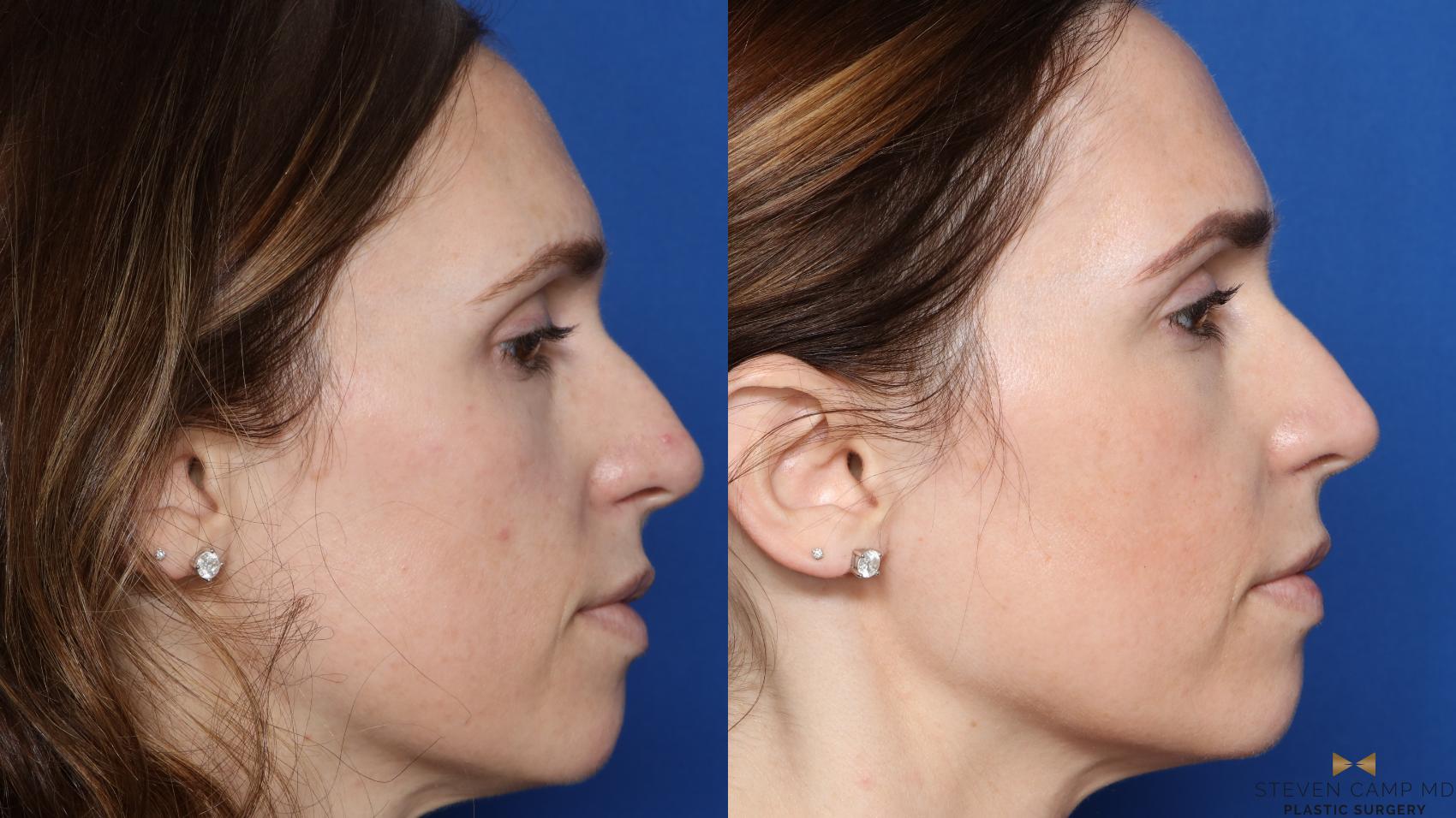 Before & After Sciton Laser Case 448 Right Side View in Fort Worth & Arlington, Texas