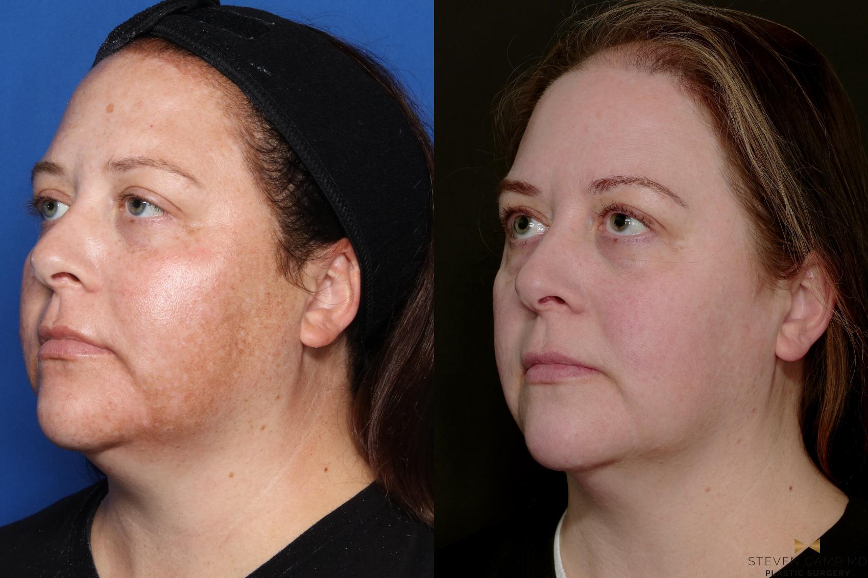 Lasers with Melasma