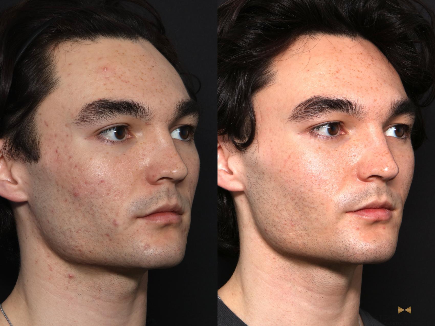Before & After SkinPen Case 731 Right Oblique View in Fort Worth & Arlington, Texas