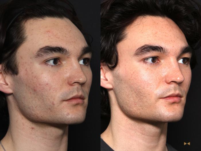 Before & After SkinPen Case 731 Right Oblique View in Fort Worth & Arlington, Texas