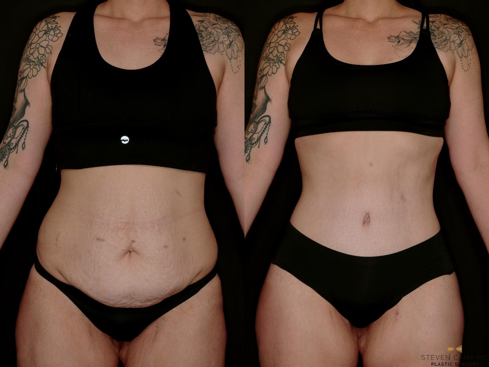 Before & After Tummy Tuck Case 736 Front View in Fort Worth & Arlington, Texas