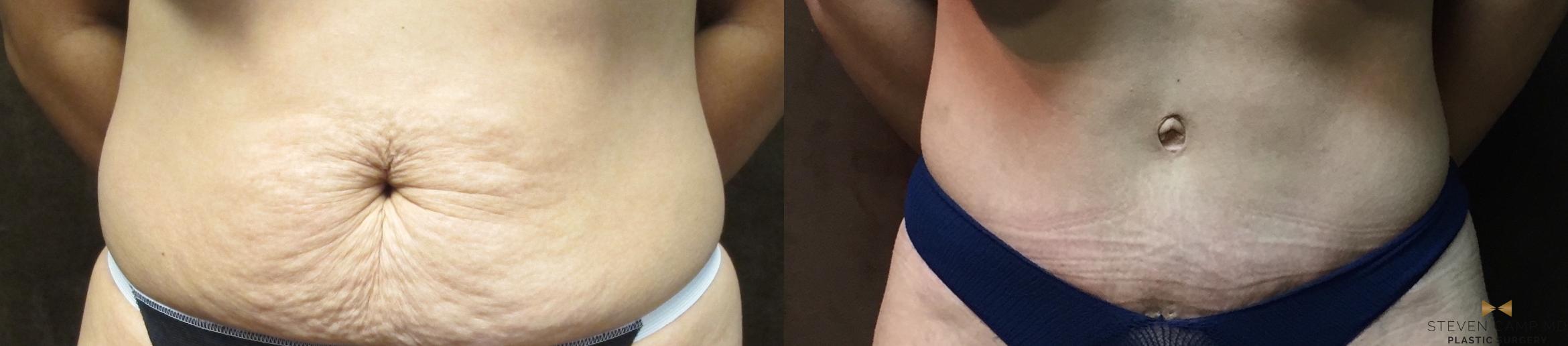 Tummy Tuck Before & After Photo | Fort Worth, Texas | Steven Camp MD Plastic Surgery