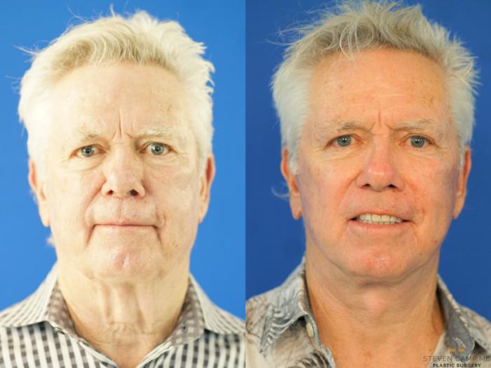Before & After Necklift Case 339 Front View in Fort Worth & Arlington, Texas