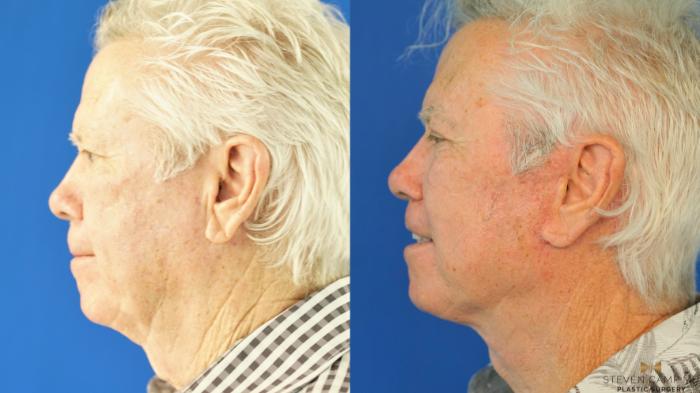 Before & After Blepharoplasty Case 339 Left Side View in Fort Worth & Arlington, Texas