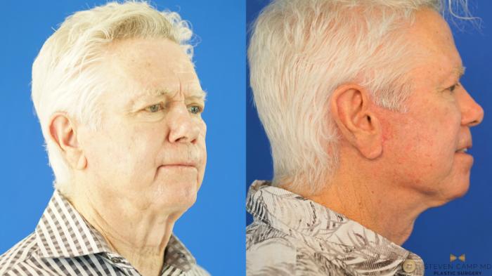 Before & After Blepharoplasty Case 339 Right Oblique View in Fort Worth & Arlington, Texas