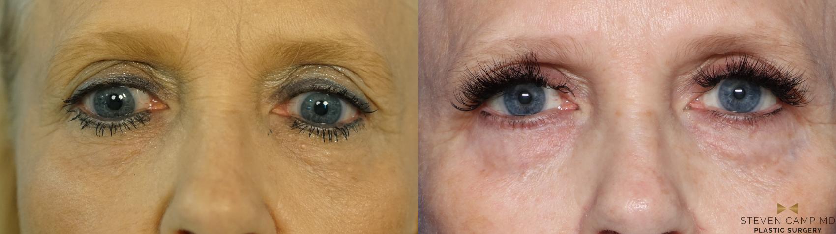 Before & After Blepharoplasty Case 385 Front View in Fort Worth & Arlington, Texas