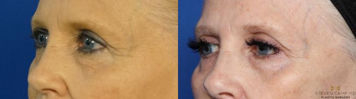 Before & After Blepharoplasty Case 385 Left Oblique View in Fort Worth, Texas