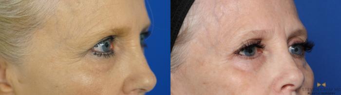 Before & After Blepharoplasty Case 385 Right Oblique View in Fort Worth, Texas