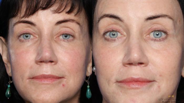 Before & After Blepharoplasty Case 544 Front View in Fort Worth, Texas