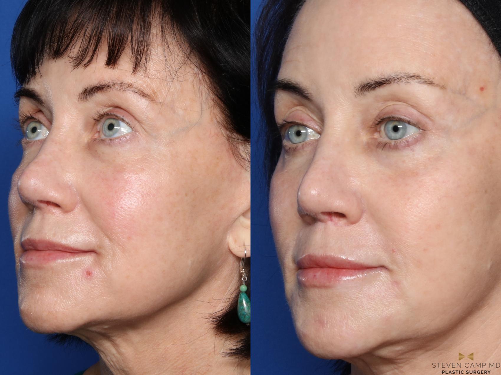 Before & After Sciton Laser Case 544 Left Oblique View in Fort Worth, Texas