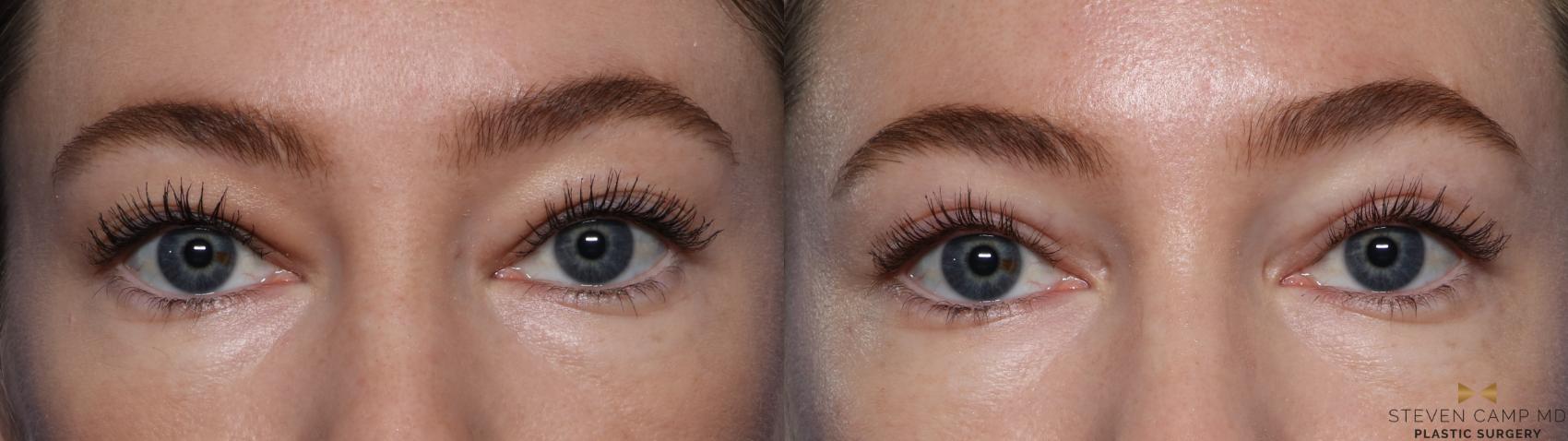 Before & After Blepharoplasty Case 546 Front View in Fort Worth & Arlington, Texas