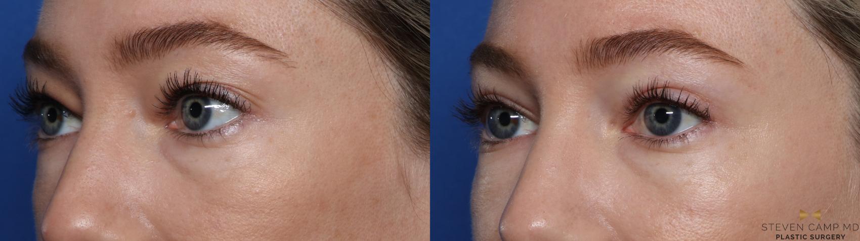 Before & After Blepharoplasty Case 546 Left Oblique View in Fort Worth, Texas