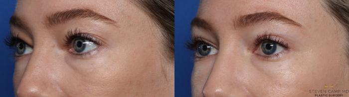 Before & After Blepharoplasty Case 546 Left Oblique View in Fort Worth, Texas
