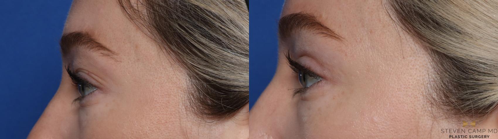 Before & After Blepharoplasty Case 546 Left Side View in Fort Worth & Arlington, Texas