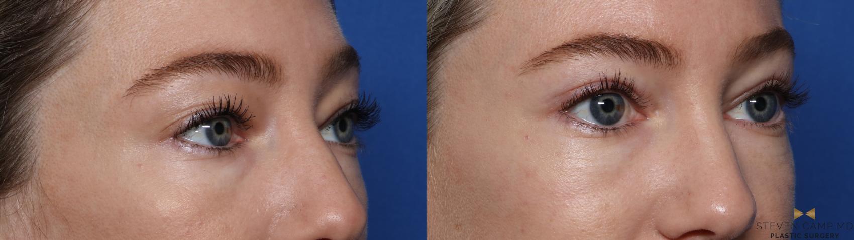 Before & After Blepharoplasty Case 546 Right Oblique View in Fort Worth & Arlington, Texas