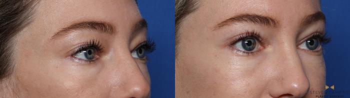 Before & After Blepharoplasty Case 546 Right Oblique View in Fort Worth, Texas