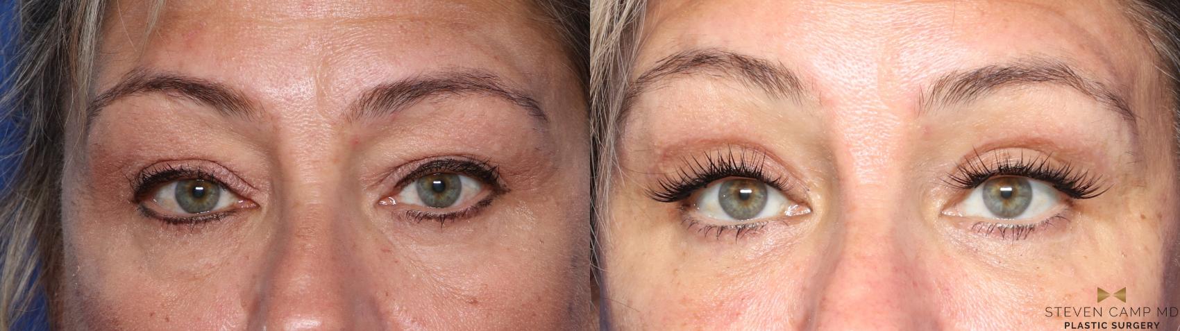 Before & After Blepharoplasty Case 565 Front View in Fort Worth, Texas