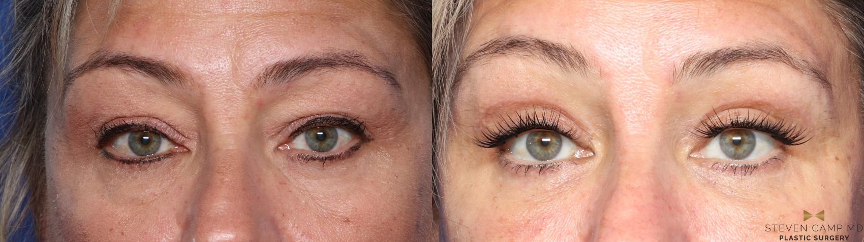 Before & After Blepharoplasty Case 565 Front View in Fort Worth & Arlington, Texas