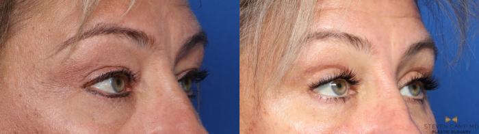 Before & After Blepharoplasty Case 565 Left Oblique View in Fort Worth, Texas