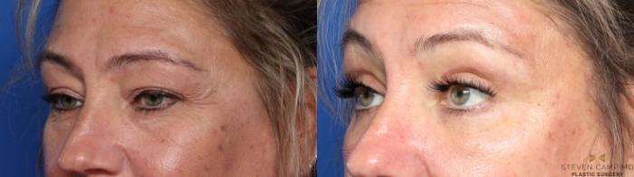 Before & After Blepharoplasty Case 565 Right Oblique View in Fort Worth, Texas