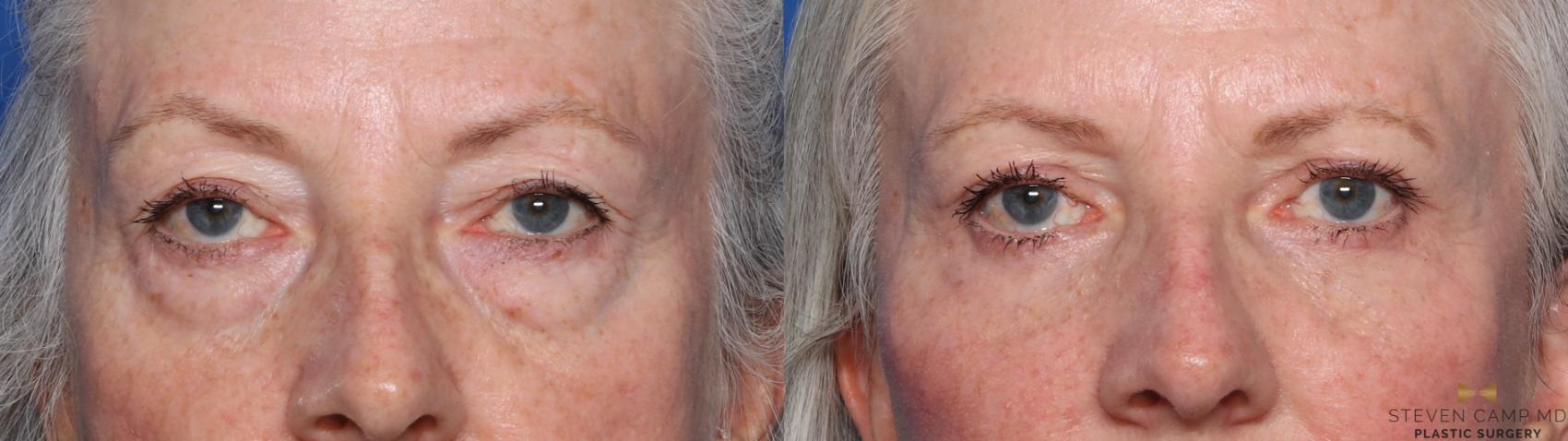 Before & After Blepharoplasty Case 566 Front View in Fort Worth & Arlington, Texas