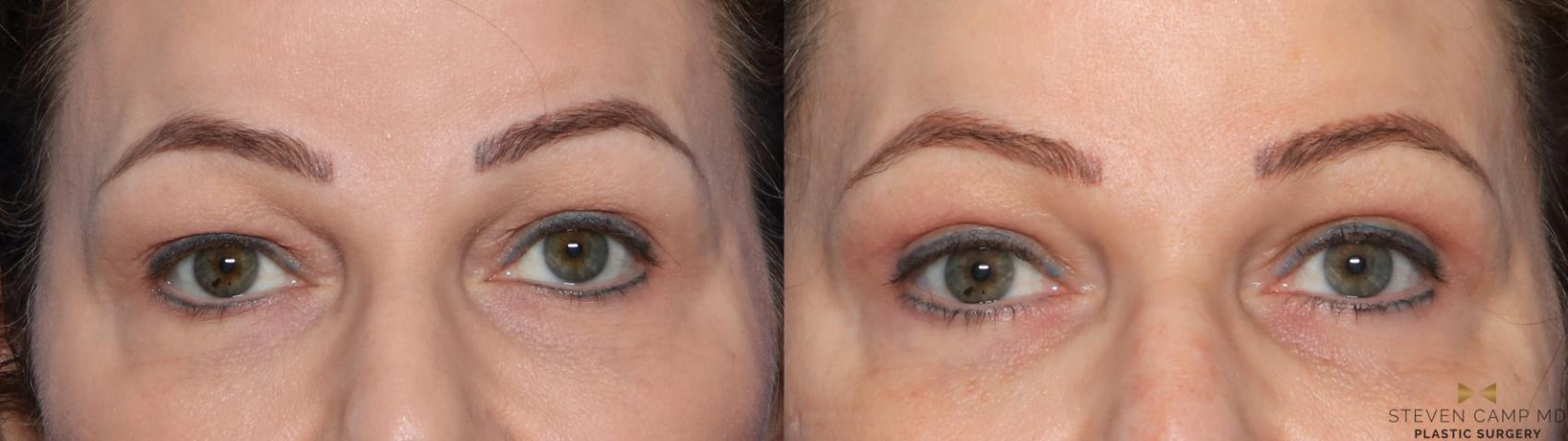 Before & After Blepharoplasty Case 573 Front View in Fort Worth & Arlington, Texas