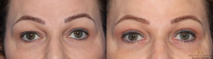 Before & After Blepharoplasty Case 573 Front View in Fort Worth, Texas