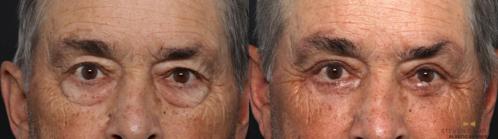 Before & After Blepharoplasty Case 618 Front View in Fort Worth & Arlington, Texas
