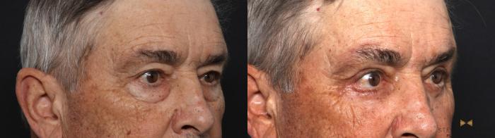 Before & After Blepharoplasty Case 618 Left Oblique View in Fort Worth & Arlington, Texas