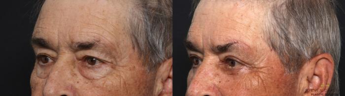 Before & After Blepharoplasty Case 618 Right Oblique View in Fort Worth & Arlington, Texas