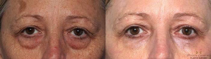 Before & After Blepharoplasty Case 636 Close up to view lower eyelids View in Fort Worth & Arlington, Texas