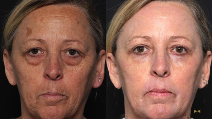 Before & After Blepharoplasty Case 636 Front View in Fort Worth & Arlington, Texas